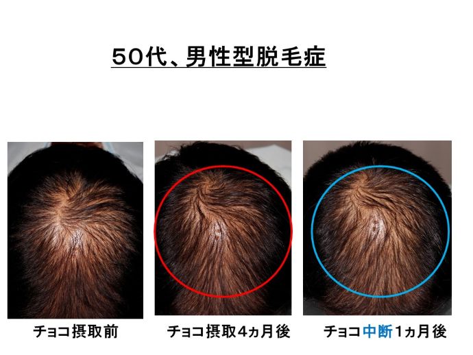 円形脱毛症　病院